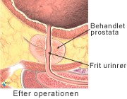 Prostata-efter-op.jpg