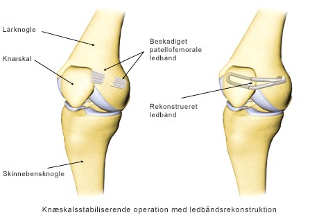 Løs knæskal – skadespausen | Aleris
