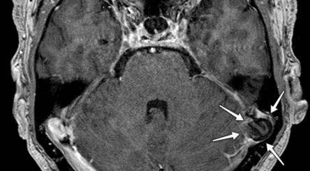 Axial t1 contrast annoteret_540x300.png